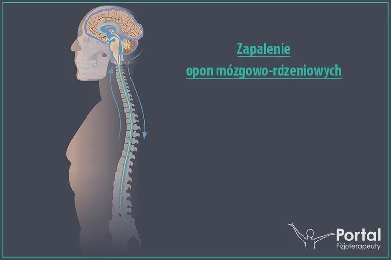 Bakteryjne zapalenie opon mózgowych: pierwsze sygnały i kiedy zgłosić się po pomoc