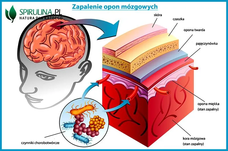 Objawy zapalenia opon mózgowych